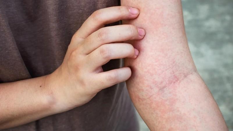 Study Finds Common Microbe That Causes Persistent Itching Study Finds Common Microbe That Causes Persistent Itching