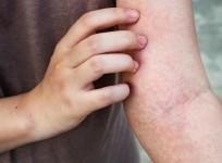 Study Finds Common Microbe That Causes Persistent Itching