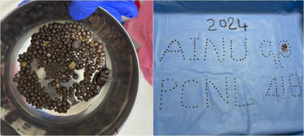 418 Kidney Stones Removed From Patient At Hyderabad's AINU. 418 Kidney Stones Removed From Patient At Hyderabad's AINU