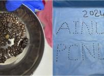 418 Kidney Stones Removed From Patient At Hyderabad's AINU
