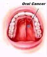 Why India is seeing a rise in oral cancer cases Why India is seeing a rise in oral cancer cases