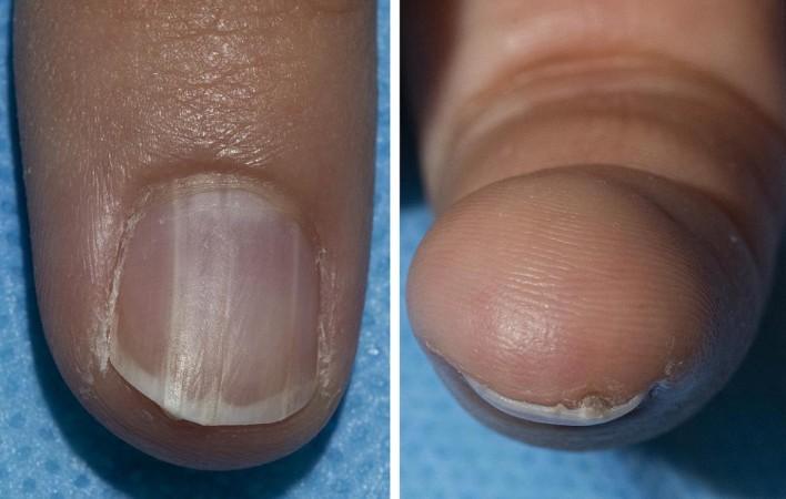 Coloured band across nail Coloured band across nail