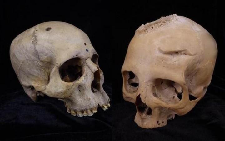 Cut marks on 4,000-yr-old skulls show ancient Egyptians tried to treat cancer skulls