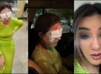 'I couldn't see properly after a while':Jasmin Bhasin suffers corneal damage; lens mishap leaves her in pain