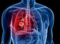 Lung cancer is most common cancer to spread to brain: Experts