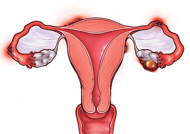 uterine fibroids in young women