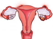 uterine fibroids in young women