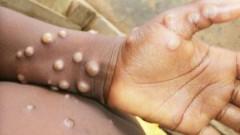 Closely monitoring monkeypox situation, no new reported cases in India