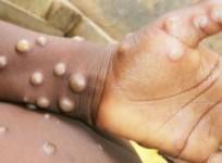 Closely monitoring monkeypox situation, no new reported cases in India