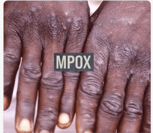 WHO declares mpox as a MPOX
