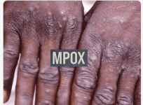 MPOX