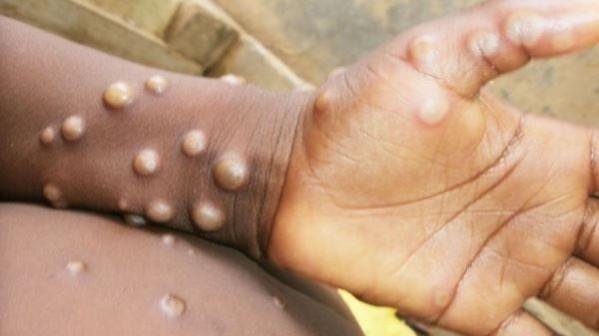 Tamil Nadu health authorities said that the state has in place mass fever screening systems at all four international airports Mpox