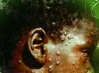 New Mpox strain poses a notable risk to children: Experts