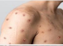 First MPox case confirmed in Kerala