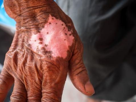 Jordan first country to eliminate leprosy: WHO