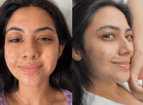 Reem Shaikh burnt before and after pics