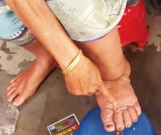 How India is fighting against lymphatic filariasis