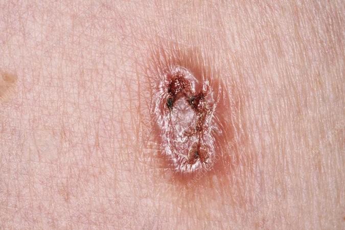 Ulcerated basal cell carcinoma Ulcerated basal cell carcinoma - Stock Image - C040/1402 - Science Photo Library Get this image on: Science Photo Library | License details Creator: DR P. MARAZZI/SCIENCE PHOTO LIBRARY | Credit: DR P. MARAZZI/SCIENCE PHOTO LIBRARY Copyright: DR P. MARAZ
