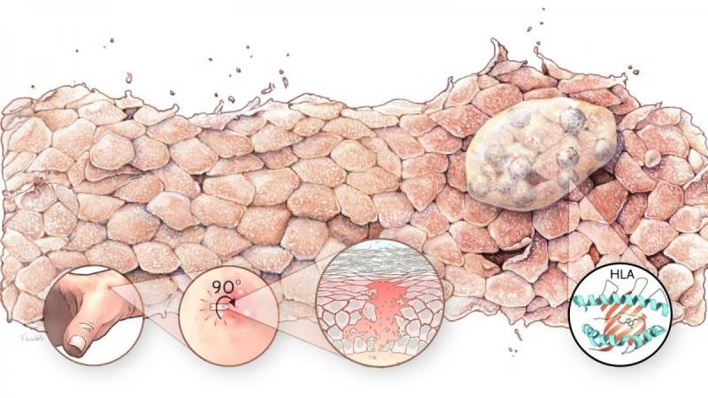 Australian-German research finds world-first cure for deadly skin disease