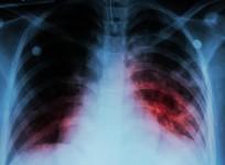 21.69 lakh TB cases notified between Jan-Oct: Centre