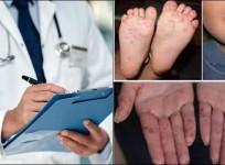 Global prevalence of atopic dermatitis to reach 42.42 mn by 2033