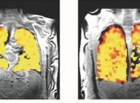Scientists develop scan that unravels secrets of lung function