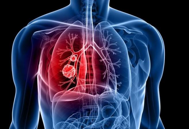 Study shows tumour DNA in blood can predict lung cancer outcome