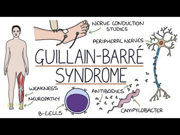 Guillain-Barré Syndrome Guillain-Barré Syndrome