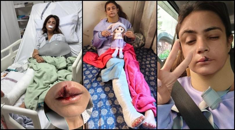 'My memory is blurred after the crash I woke up in hospital with lips broken, dental, leg fractures..': Shweta Rohira reveals terrifying bike accident [Exclusive]