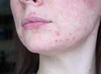 Combination immunotherapy may cure patients with deadly advanced skin cancer