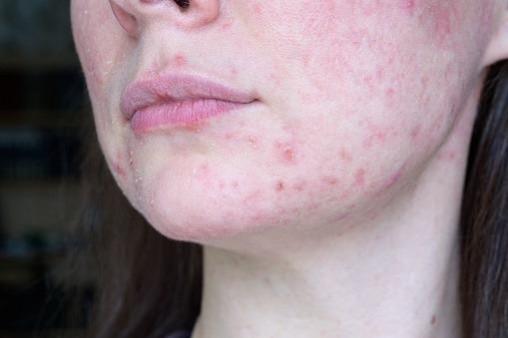 Combination immunotherapy may cure patients with deadly advanced skin cancer Combination immunotherapy may cure patients with deadly advanced skin cancer