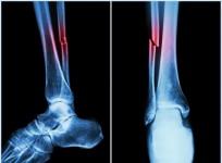 New machine algorithm can identify heart, fracture risks with routine bone scans