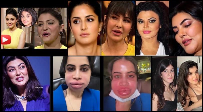 Urfi Javed flaunts swollen face after dissolving lip fillers; Shanaya Kapoor, Sushmita Sen & others who've opted for lip fillers Urfi Javed flaunts swollen face after dissolving lip fillers; Shanaya Kapoor, Sushmita Sen & others who've opted for lip fillers