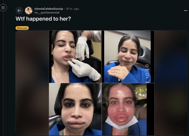 Uorfi Javed flaunts swollen face as she dissolves lip fillers Uorfi Javed flaunts swollen face as she dissolves lip fillers
