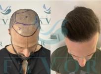 Top 10 Best Hair Transplant Clinics in Turkey