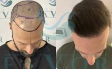 Top 10 Best Hair Transplant Clinics in Turkey
