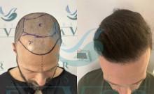 Top 10 Best Hair Transplant Clinics in Turkey Top 10 Best Hair Transplant Clinics in Turkey