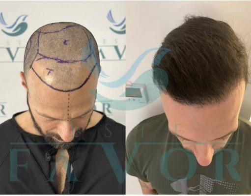 Top 10 Best Hair Transplant Clinics in Turkey