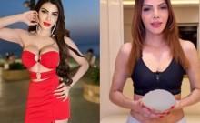 Sherlyn Chopra breast implants removed
