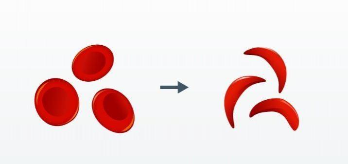 India launches 1st indigenous CRISPR-based gene therapy for Sickle Cell Disease India launches 1st indigenous CRISPR-based gene therapy for Sickle Cell Disease