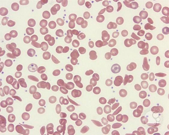 India launches 1st indigenous CRISPR-based gene therapy for Sickle Cell Disease