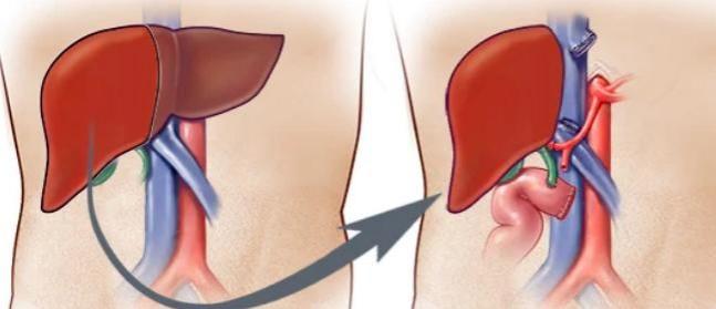 India's Medical Expertise Shines in Living Donor Liver Transplant Field India's Medical Expertise Shines in Living Donor Liver Transplant Field