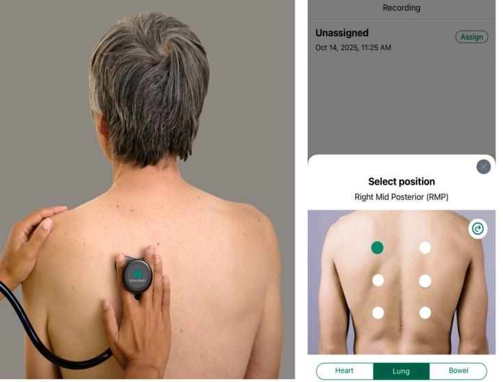 AI-powered digital stethoscopes show promise in bridging screening gaps