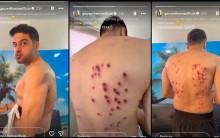 'Same pellet guns as NEET protesters?' : Fans react to Gaurav Khanna's injury on Khatron Ke Khiladi 15; makers clarify, 'It is not at all brutal'