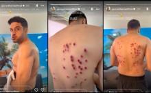 'Same pellet guns as NEET protesters?' : Fans react to Gaurav Khanna's injury on Khatron Ke Khiladi 15; makers clarify, 'It is not at all brutal'