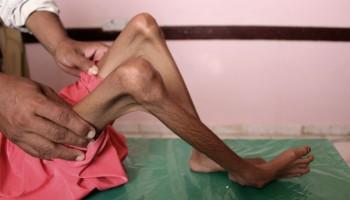 Yemeni Civil War,Yemeni Army,yemeni,Yemeni Rebels,Shiite Huthi rebels,malnutrition,malnutrition in yemen,save the children,save the children NGO