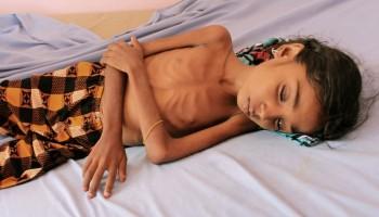 Yemeni Civil War,Yemeni Army,yemeni,Yemeni Rebels,Shiite Huthi rebels,malnutrition,malnutrition in yemen,save the children,save the children NGO