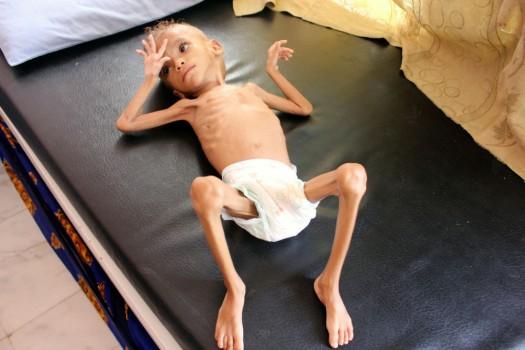 Shocking pictures of Yemeni children suffering from malnutrition will break your heart!