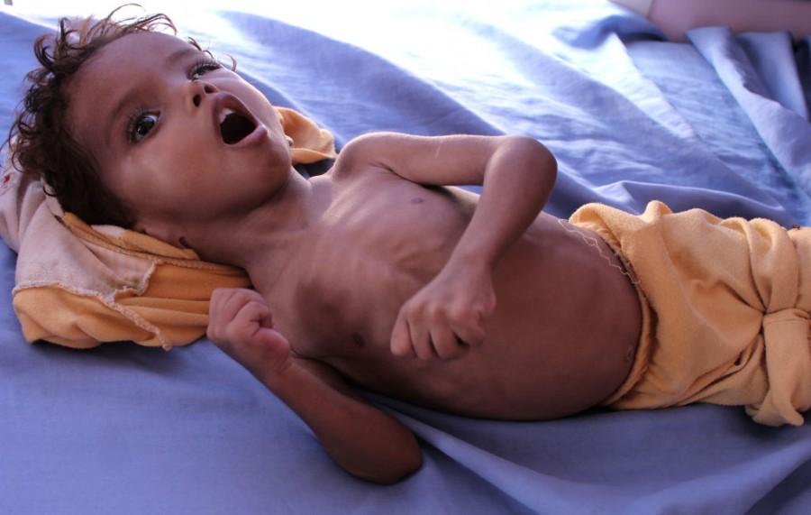 Shocking pictures of Yemeni children suffering from malnutrition will break your heart! Yemeni children,Devastating pictures of Yemeni children,Yemeni children malnutrition,malnutrition Yemeni children,malnutrition children