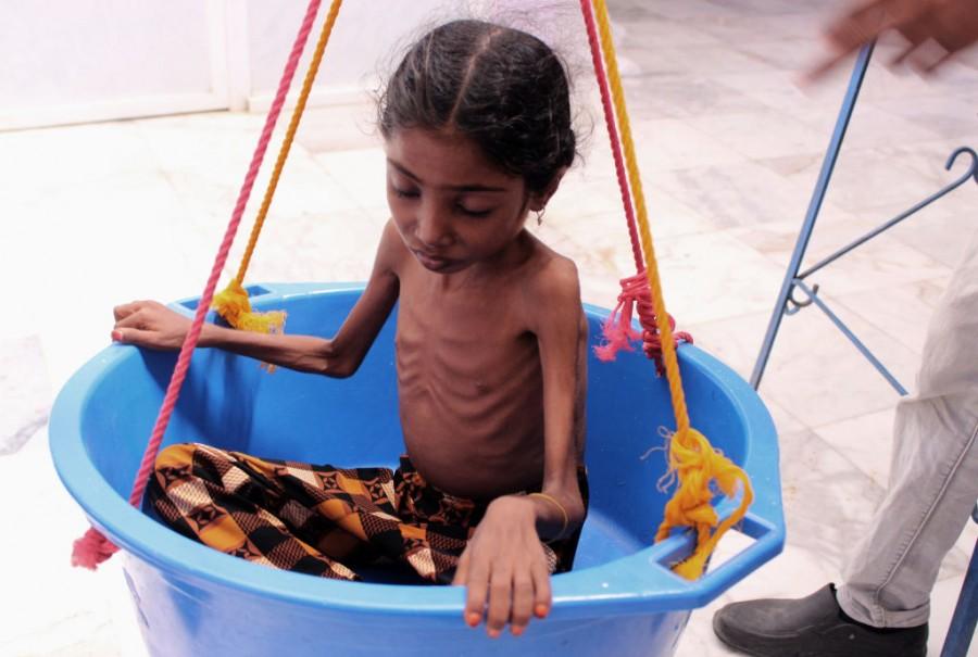 Shocking pictures of Yemeni children suffering from malnutrition will break your heart! Yemeni children,Devastating pictures of Yemeni children,Yemeni children malnutrition,malnutrition Yemeni children,malnutrition children